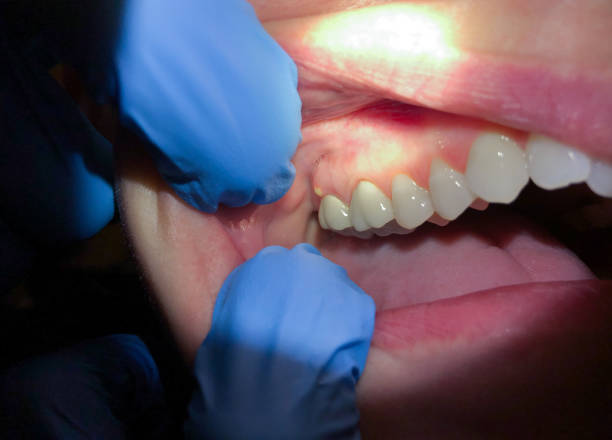 Best Affordable Emergency Dental Care  in Lake Tapps, WA